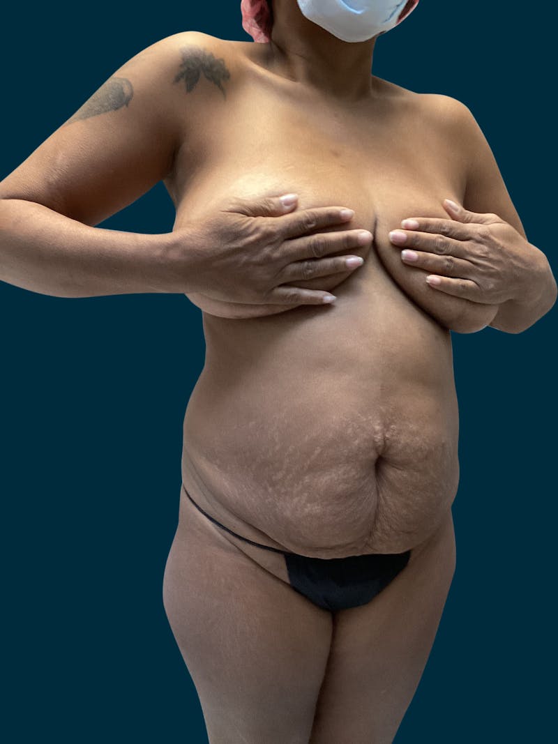 Abdominoplasty Before & After Gallery - Patient 242083 - Image 5
