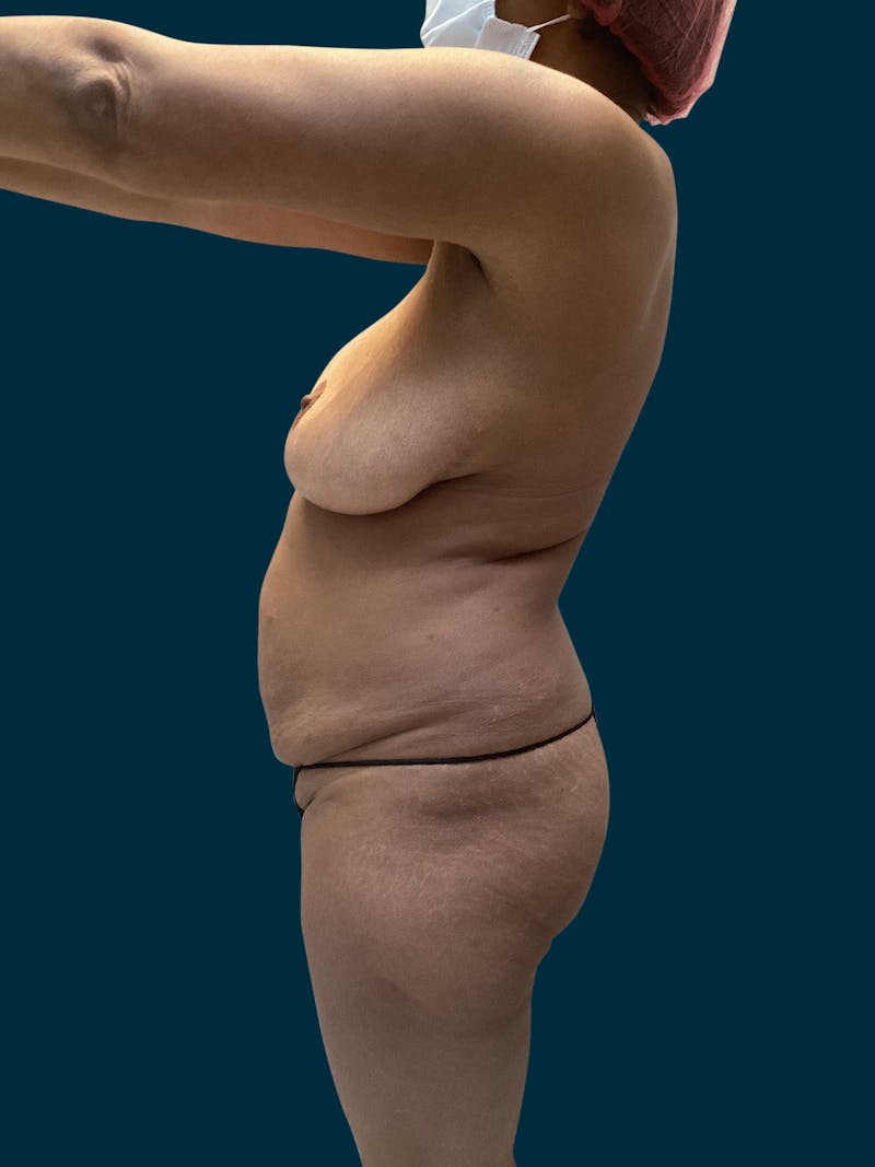 Abdominoplasty Before & After Gallery - Patient 242083 - Image 7