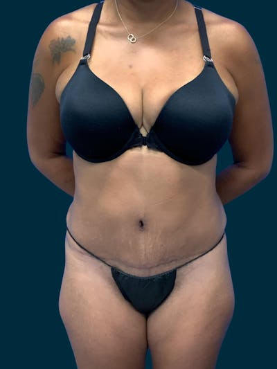 Abdominoplasty Before & After Gallery - Patient 242083 - Image 2
