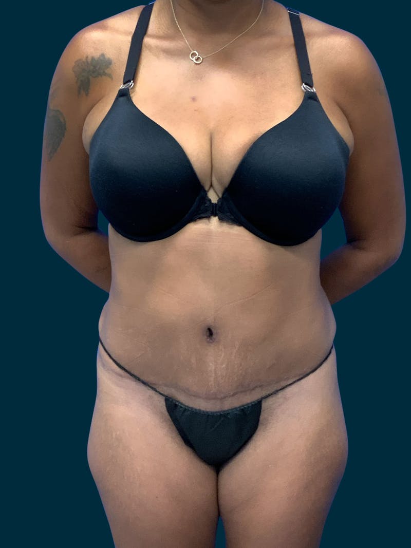 Abdominoplasty Before & After Gallery - Patient 242083 - Image 2