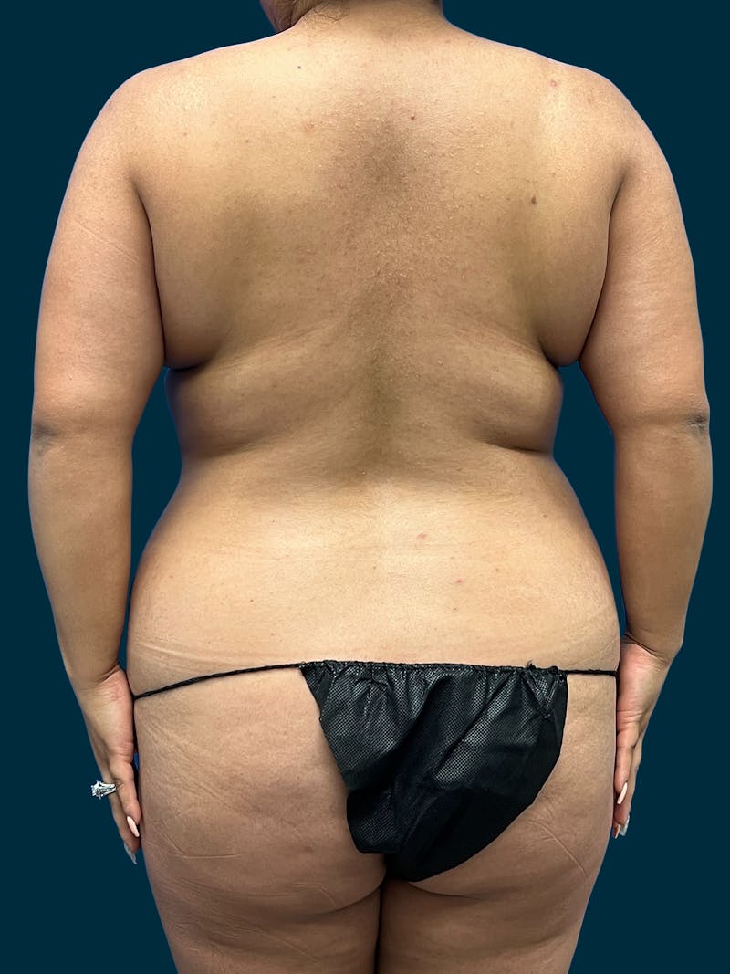 Liposuction Before & After Gallery - Patient 357768 - Image 3
