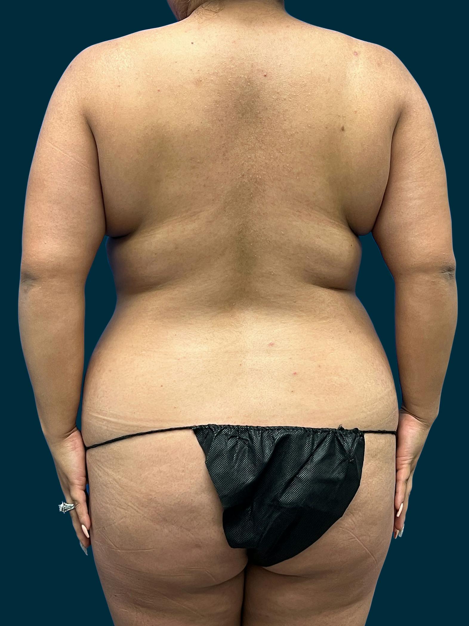 Tummy tuck patient before media
