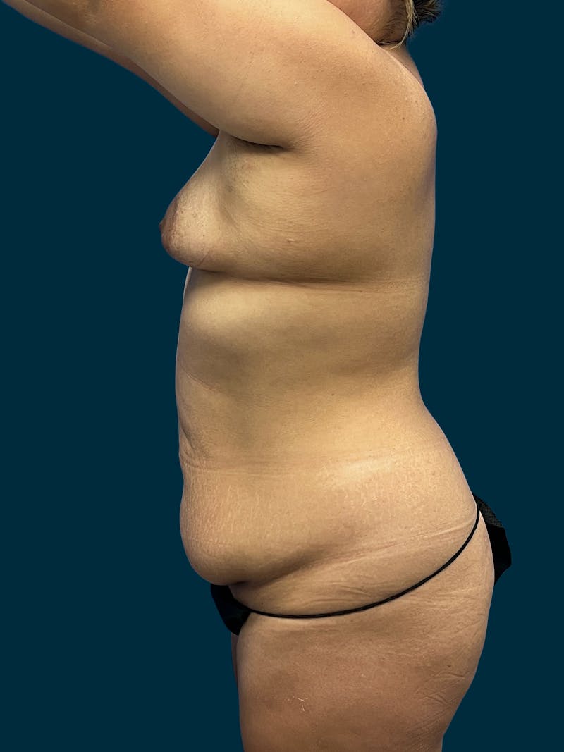 Liposuction Before & After Gallery - Patient 357768 - Image 5