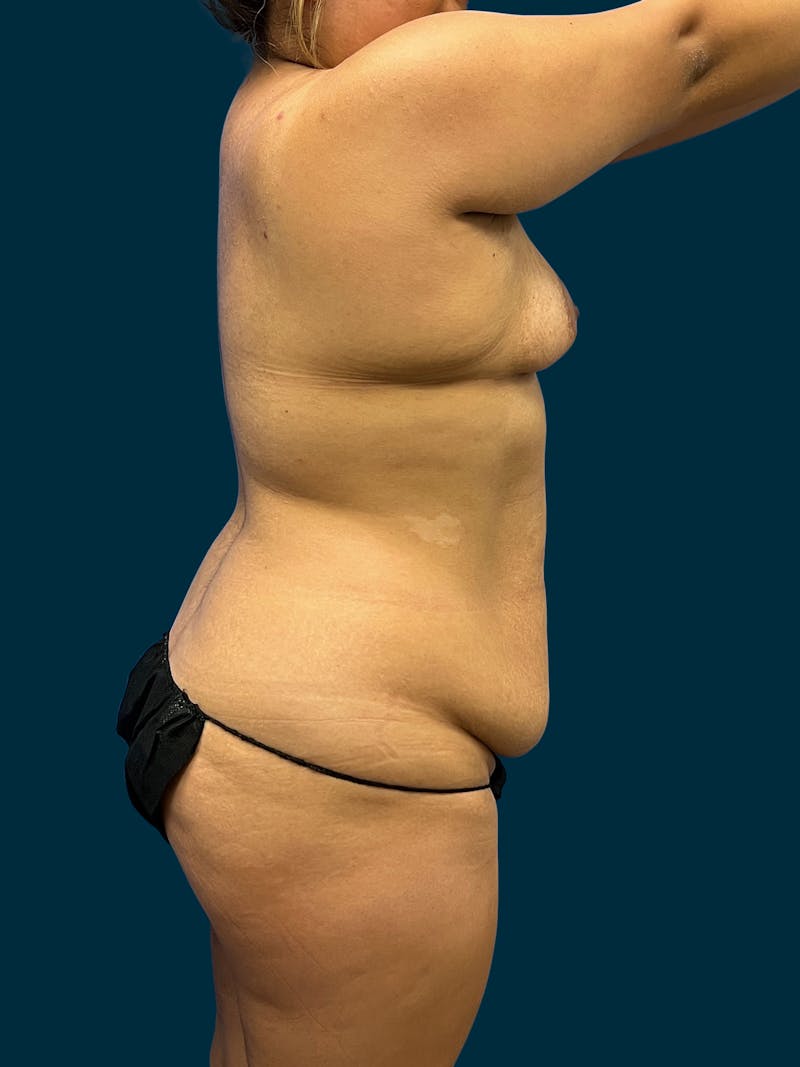 Liposuction Before & After Gallery - Patient 357768 - Image 1