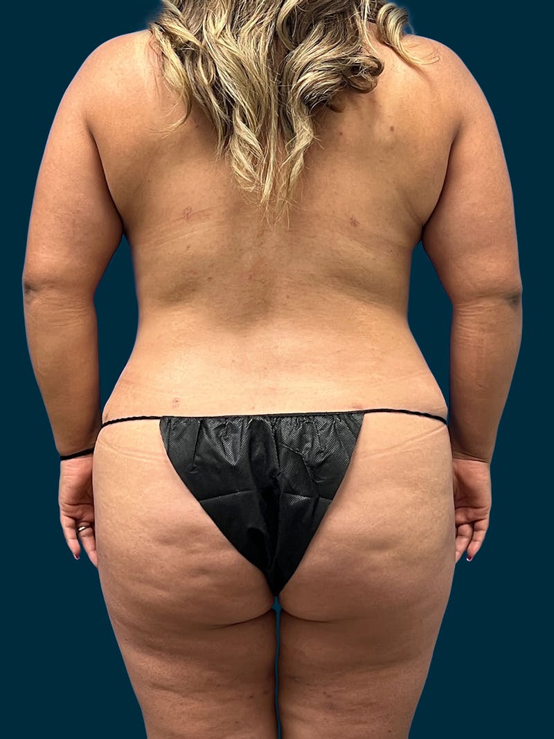 Abdominoplasty Before & After Gallery - Patient 186786 - Image 4