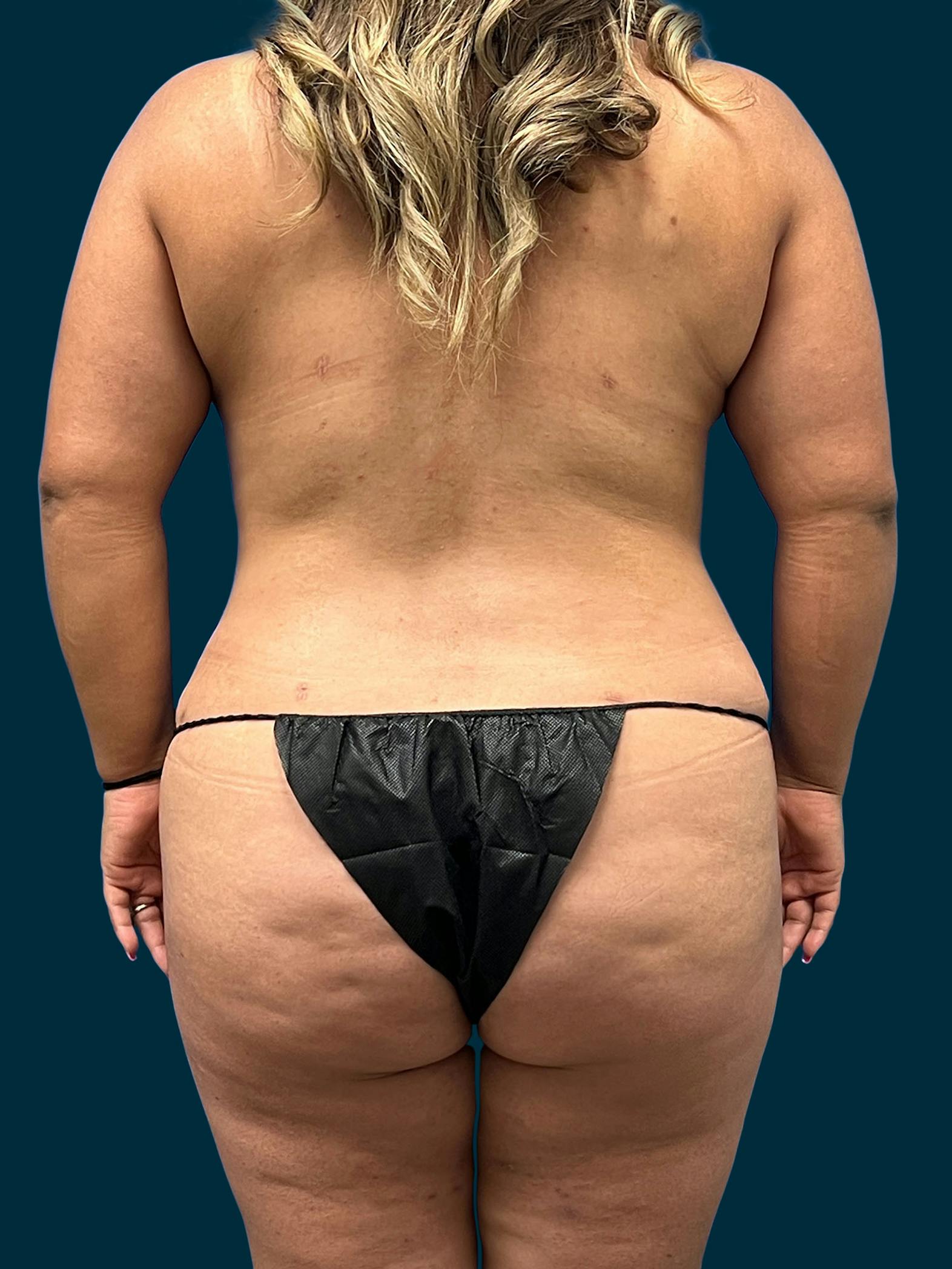 Tummy tuck patient before media