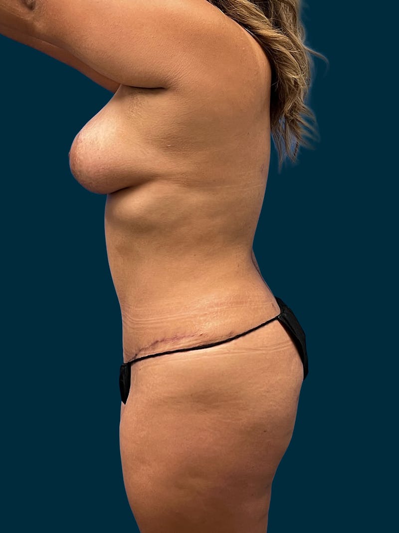 Liposuction Before & After Gallery - Patient 357768 - Image 6