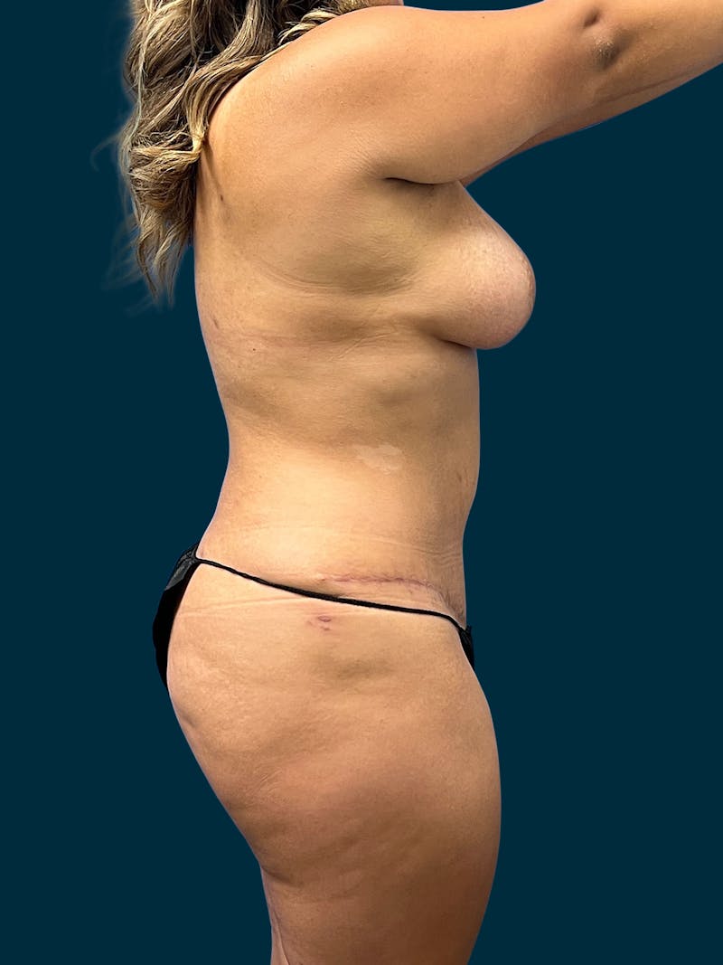 Liposuction Before & After Gallery - Patient 357768 - Image 2