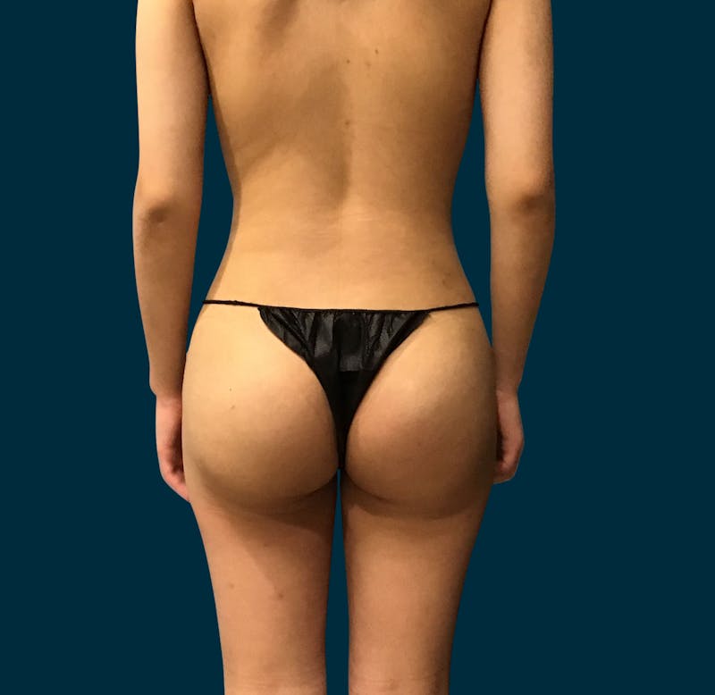 Liposuction Before & After Gallery - Patient 765065 - Image 3
