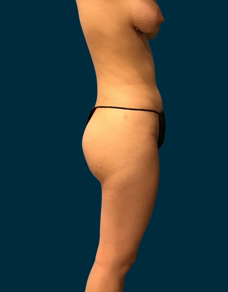 Liposuction Before & After Gallery - Patient 765065 - Image 2