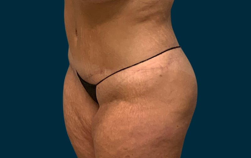 Body Lift Before & After Gallery - Patient 414261 - Image 4