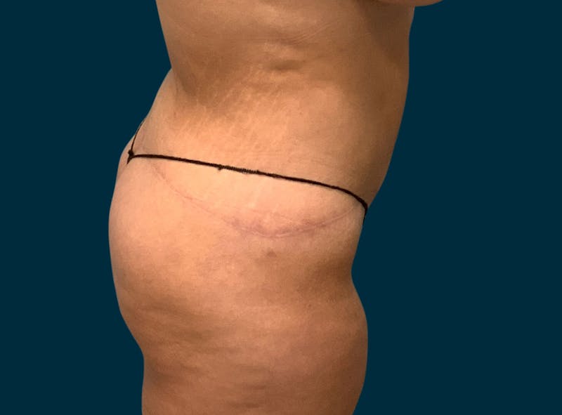 Body Lift Before & After Gallery - Patient 414261 - Image 10