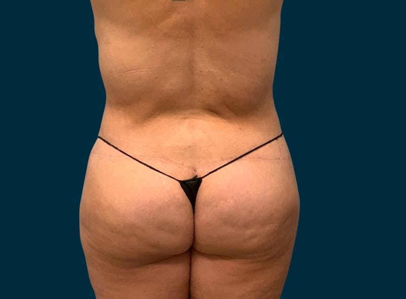 Body Lift Before & After Gallery - Patient 414261 - Image 12