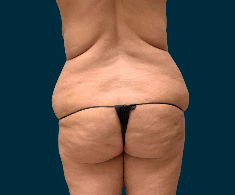Body Lift Before & After Gallery - Patient 414261 - Image 11