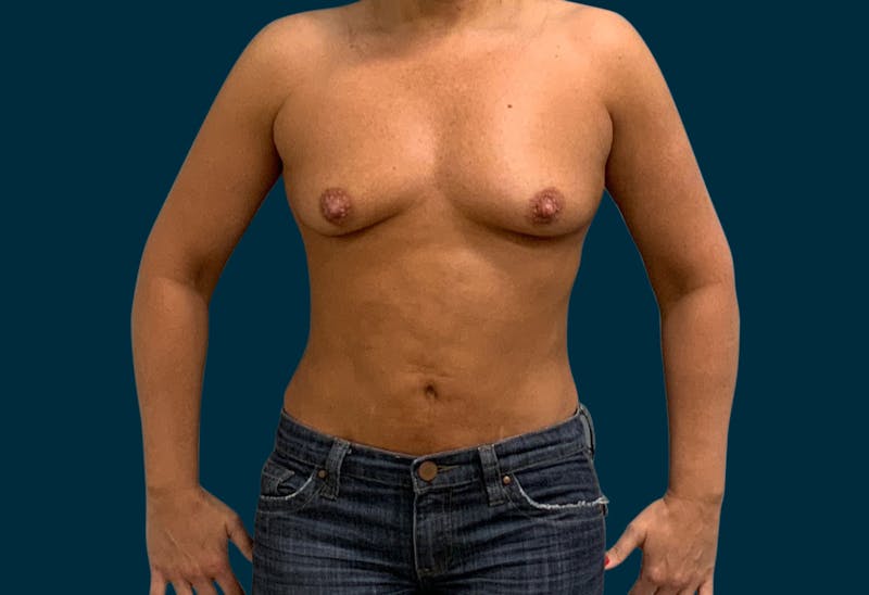 Breast Augmentation Before & After Gallery - Patient 192049 - Image 1