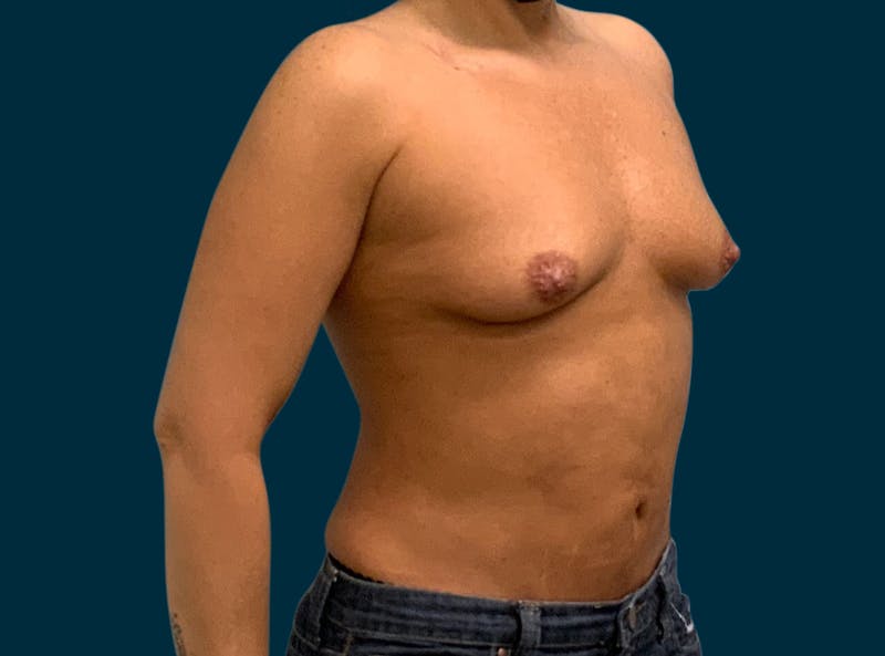 Breast Augmentation Before & After Gallery - Patient 192049 - Image 3