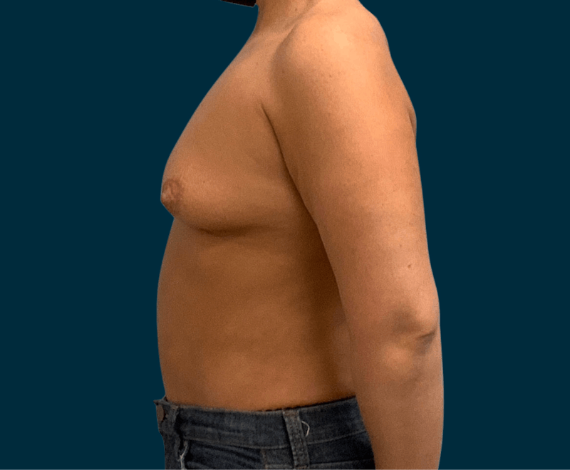Breast Augmentation Before & After Gallery - Patient 192049 - Image 5