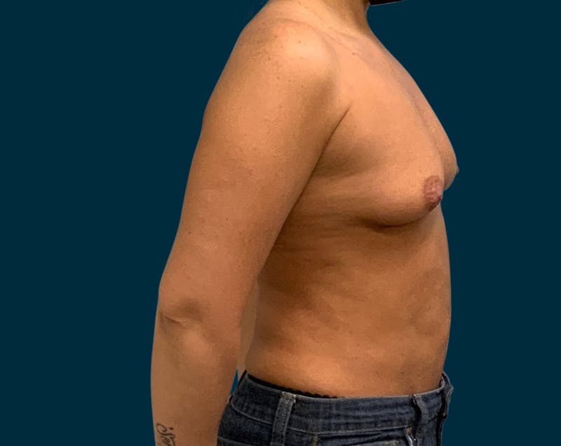Breast Augmentation Before & After Gallery - Patient 192049 - Image 7