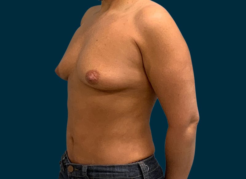 Breast Augmentation Before & After Gallery - Patient 192049 - Image 9