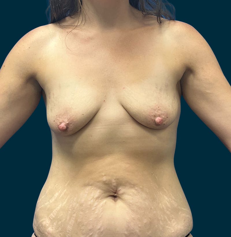 Breast Lift Before & After Gallery - Patient 377666 - Image 1