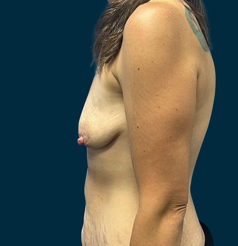 Breast Lift Before & After Gallery - Patient 377666 - Image 3
