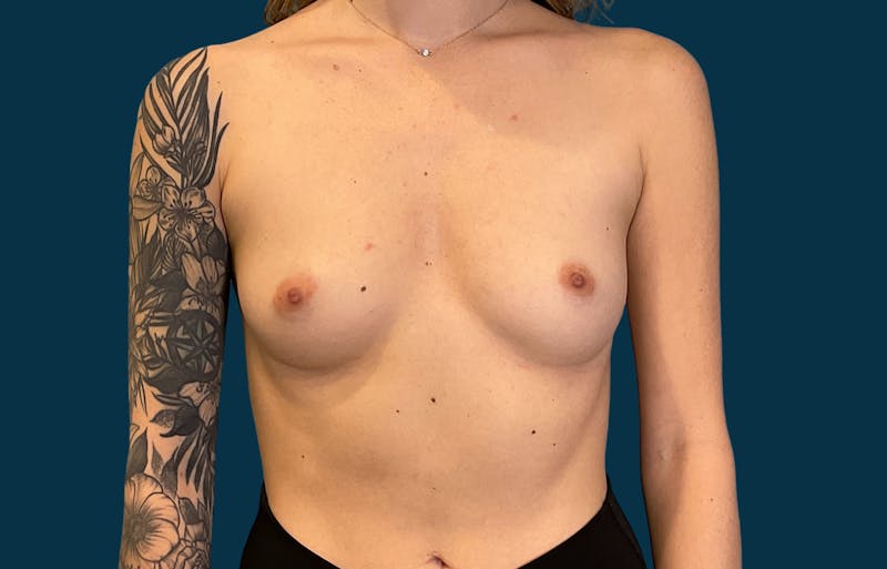 Patient aJAKtmeVRhKPx7GZszQCpg - Breast Augmentation Before & After Photos