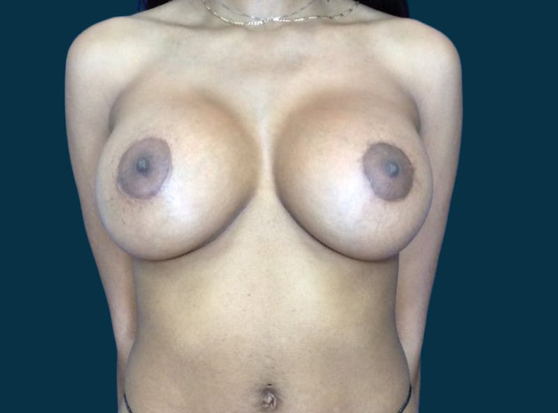 Breast Augmentation Before & After Gallery - Patient 108444 - Image 2