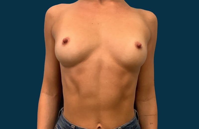 Breast Augmentation Before & After Gallery - Patient 137913 - Image 1