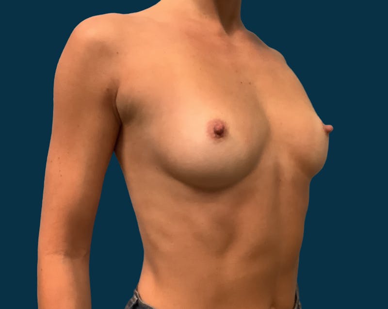 Breast Augmentation Before & After Gallery - Patient 137913 - Image 3