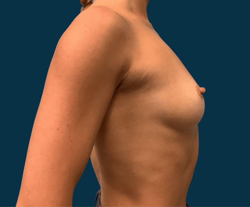 Breast Augmentation Before & After Gallery - Patient 137913 - Image 5