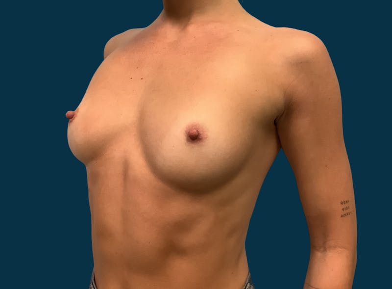Breast Augmentation Before & After Gallery - Patient 137913 - Image 7