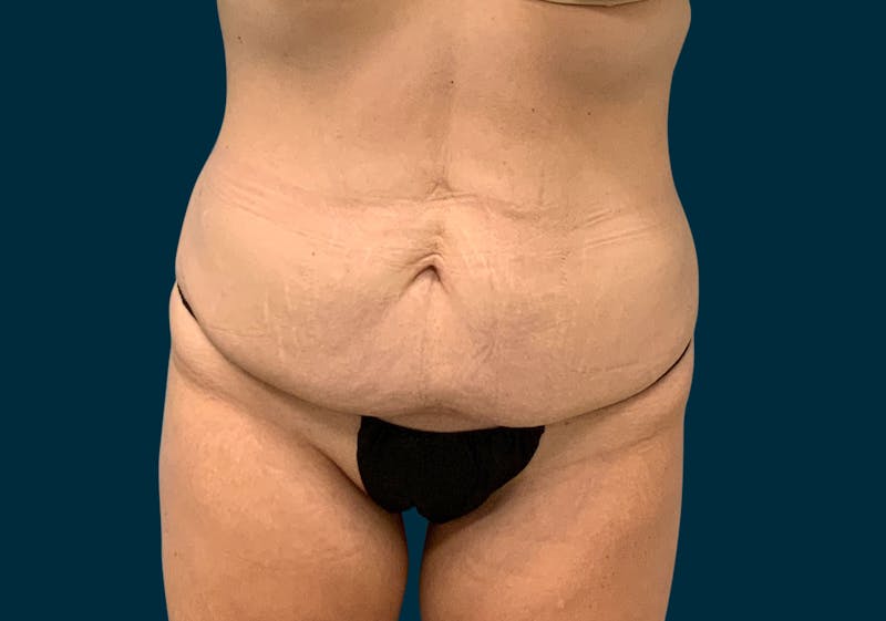 Body Lift Before & After Gallery - Patient 107372 - Image 1