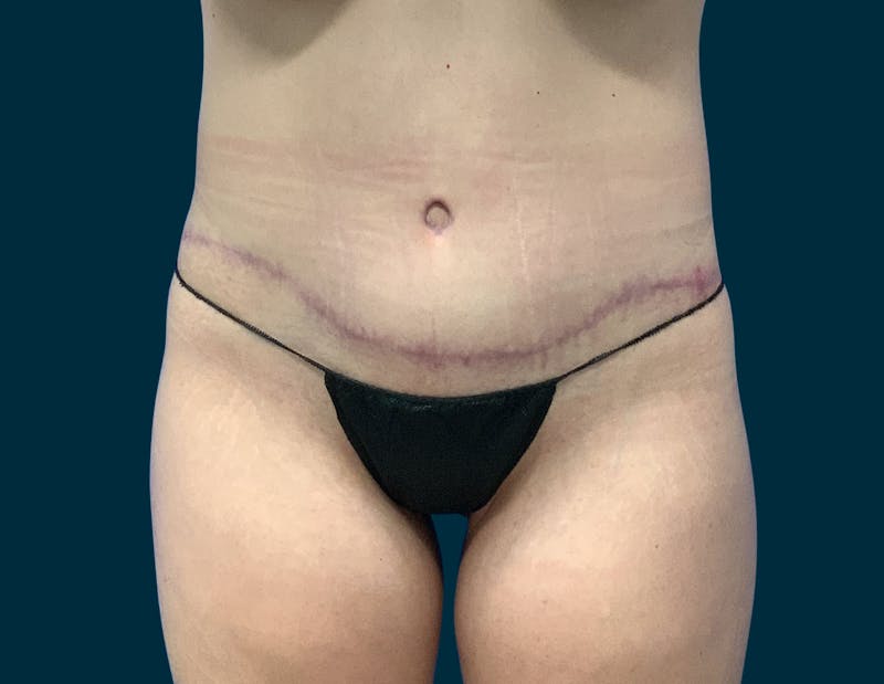 Body Lift Before & After Gallery - Patient 107372 - Image 2