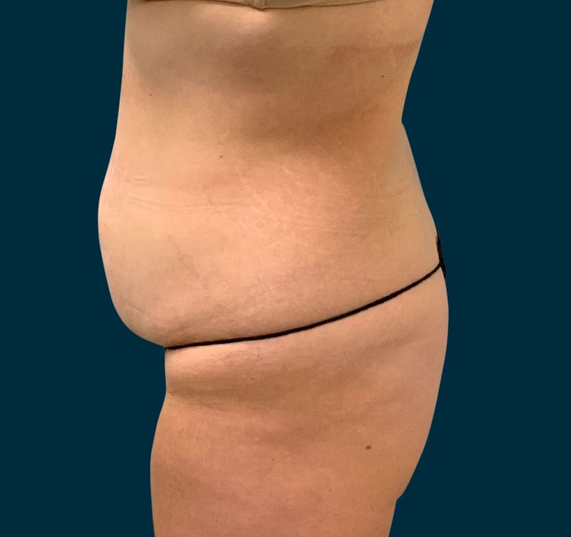 Body Lift Before & After Gallery - Patient 107372 - Image 3