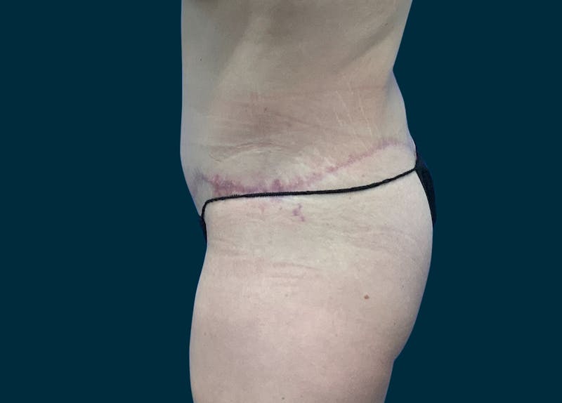Body Lift Before & After Gallery - Patient 107372 - Image 4