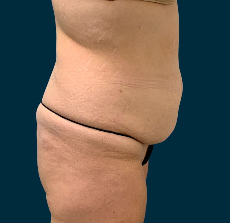 Body Lift Before & After Gallery - Patient 107372 - Image 5