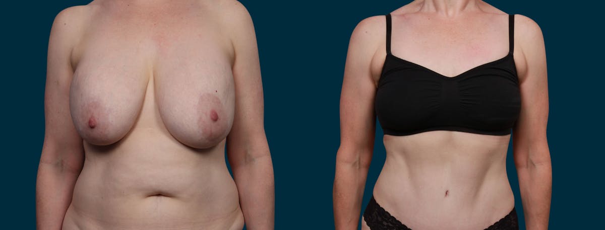 Fat Transfer Breast Augmenation Before & After Gallery - Patient 275297 - Image 1