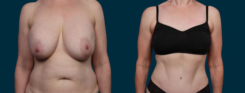 Patient E4gFYjWGSheyRIbyKeDULQ - Fat Transfer Breast Augmentation Before & After Photos