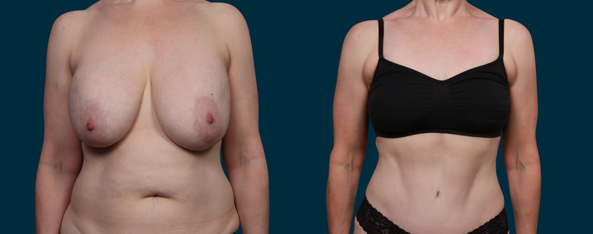 Breast Lift Before & After Gallery - Patient 179005 - Image 2