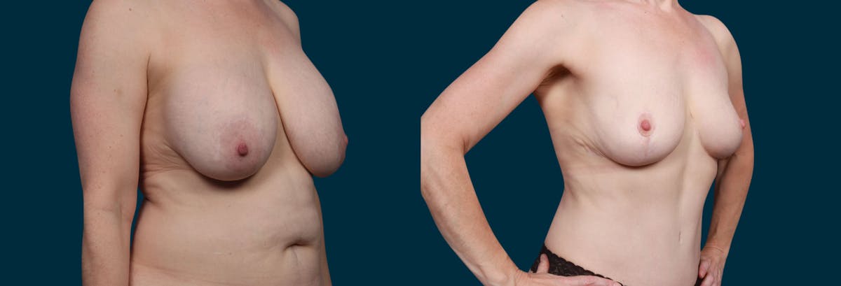 Breast Lift Before & After Gallery - Patient 179005 - Image 1