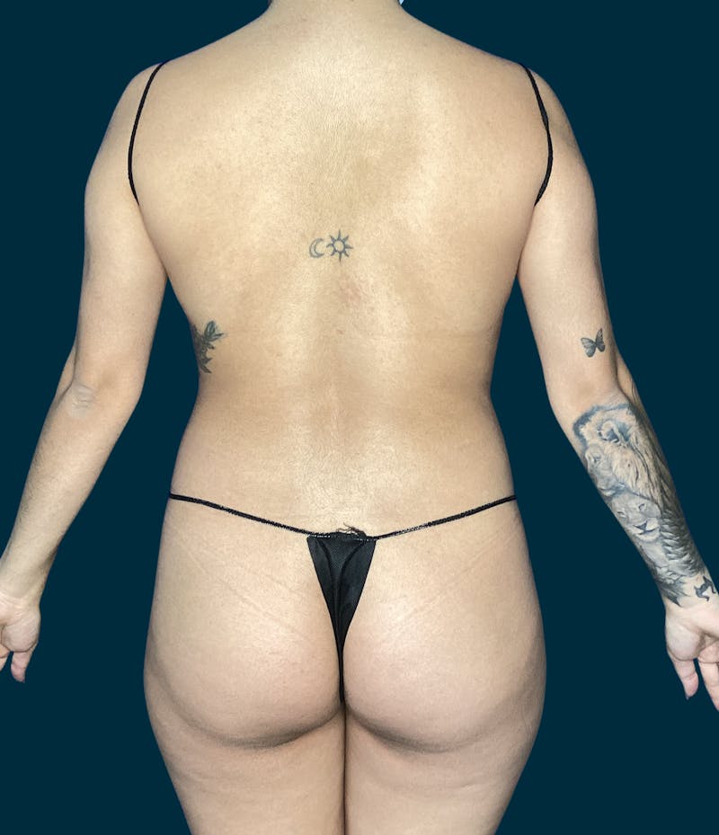 Brazilian Butt Lift Before & After Gallery - Patient 229332 - Image 1