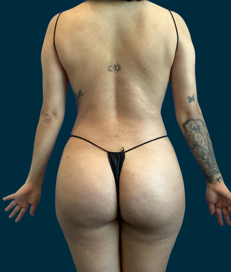 Liposuction Before & After Gallery - Patient 370566 - Image 10
