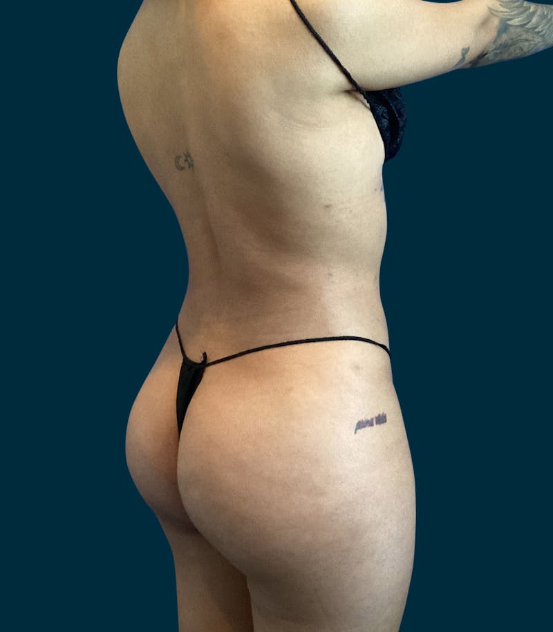 Brazilian Butt Lift Before & After Gallery - Patient 229332 - Image 6