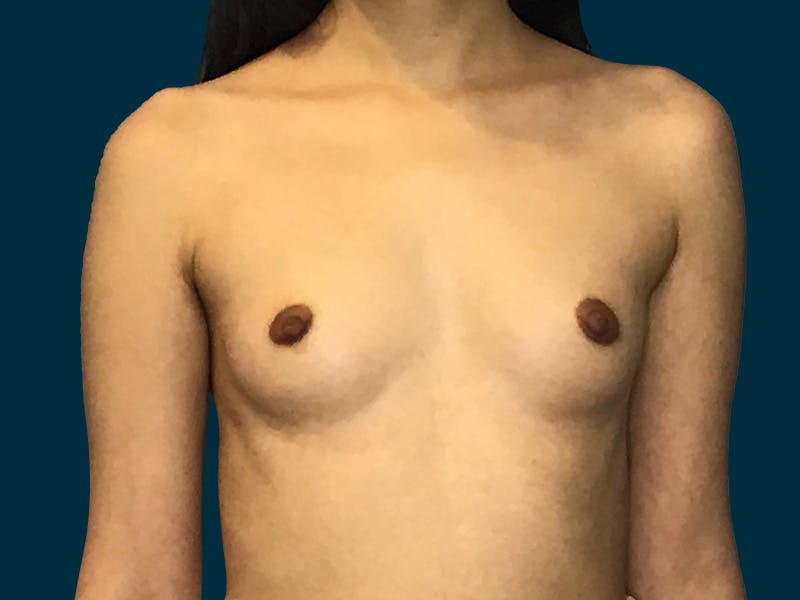 Breast Augmentation Before & After Gallery - Patient 245029 - Image 1