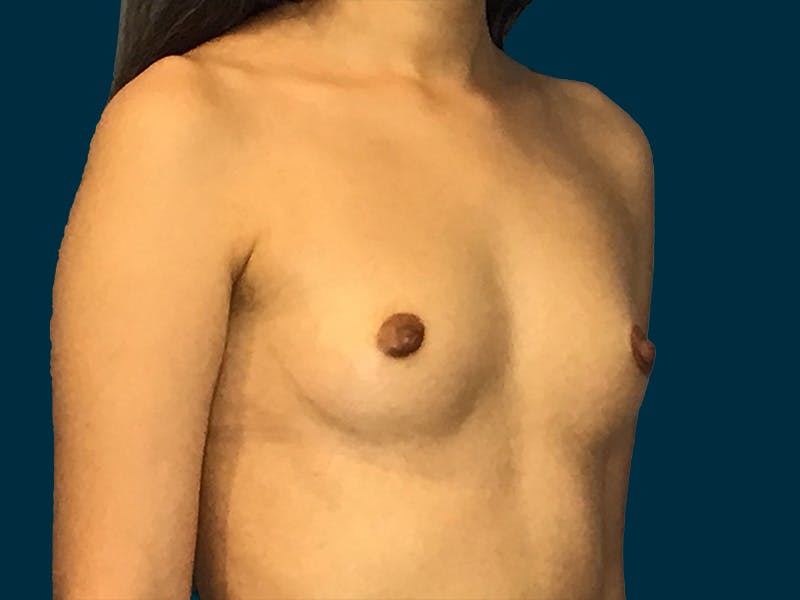 Breast Augmentation Before & After Gallery - Patient 245029 - Image 3