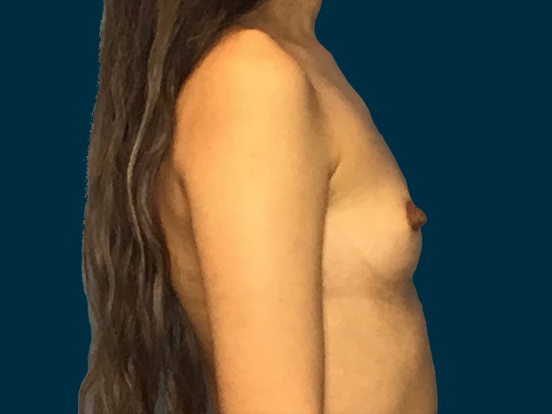 Breast Augmentation Before & After Gallery - Patient 245029 - Image 5