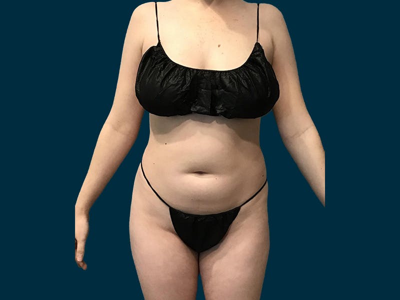 Fat Transfer Before & After Gallery - Patient 124567 - Image 3