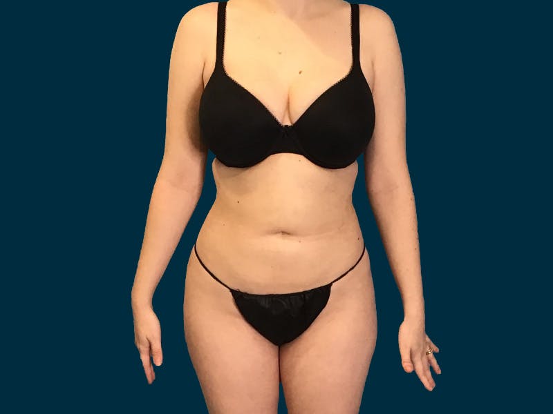 Fat Transfer Before & After Gallery - Patient 124567 - Image 4