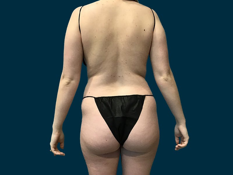 Patient VM-iHprBQb2lEx8EPpmWkQ - Brazilian Butt Lift Before & After Photos