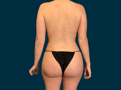 Liposuction Before & After Gallery - Patient 275125 - Image 2